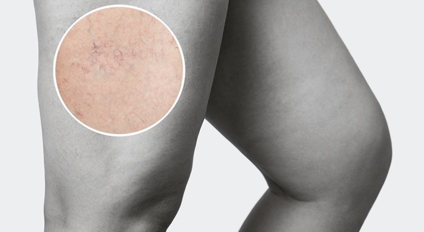 Trattamento lesioni vascolari