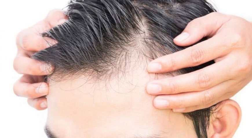 Il Trapianto di Capelli &egrave; la migliore soluzione per ritrovare una capigliatura ideale