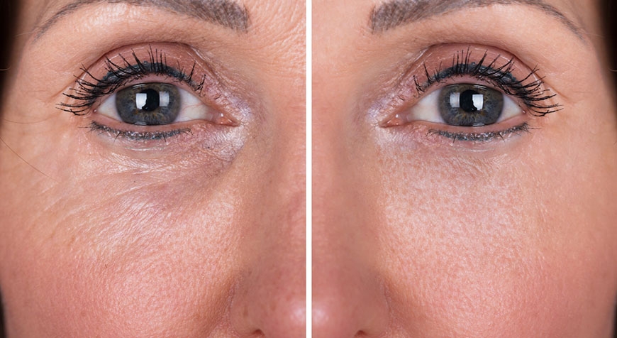 CO2 antiage: Oggi Carbossiterapia è sinonimo di ringiovanimento per viso, collo e decollete