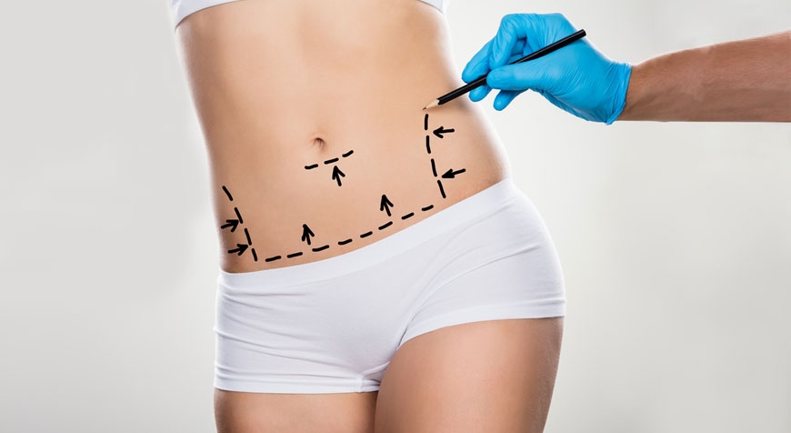Via il grasso addominale con la medicina estetica soft