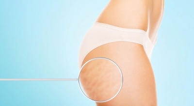 Carbossiterapia: contro la cellulite