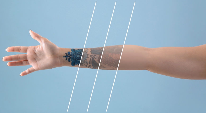 Rimozione del tatuaggio con PIQo4